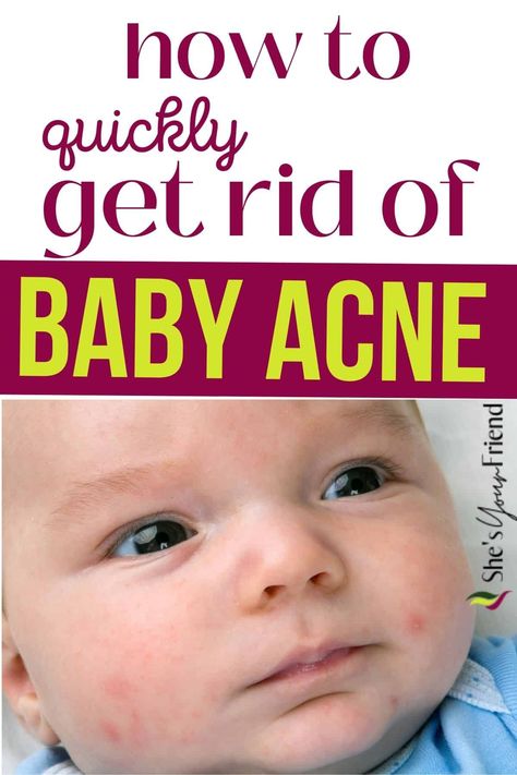 A baby with acne and text overlay that reads how to quickly get rid of baby acne Newborn Rash On Face, Baby Acne Remedy How To Get Rid Of, Baby Acne Remedy Breastmilk, Face Rash Remedies, Newborn Dry Skin, Newborn Rash, Baby Acne Remedy, Skin Rash Remedies, Baby Rash On Face