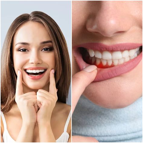 What is the Fastest Way to Heal a Gum Infection Irritated Gums Remedies, Gum Infection Remedies, Sore Gums Remedy, Sore In Mouth Remedies, Gum Sores, Diy Mouthwash, Ear Ache, Swollen Gum, Mouth Rinse