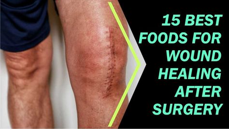 The post 15 Best Foods for Wound Healing after Surgery: Fact Checked appeared first on FoodNurish. Undergoing surgery is a major event that puts significant stress on our bodies. One crucial aspect of post-surgery recovery is wound healing. Proper nutrition plays a vital role in supporting... The post 15 Best Foods for Wound Healing after Surgery: Fact Checked appeared first on FoodNurish. Foods For Healing After Surgery, Food After Surgery Recovery, Wound Healing Foods, Healing Foods After Surgery, Healing From Surgery, Healing After Surgery, Pink Warrior, Recovery Food, Surgery Recovery