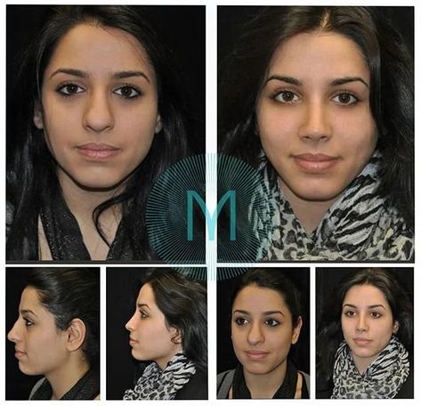 Closed Rhinoplasty, Nose Rhinoplasty, Nose Plastic Surgery, Ethnic Rhinoplasty, Bulbous Nose, Rhinoplasty Nose Jobs, Rhinoplasty Before And After, Rhinoplasty Surgery, Pretty Nose