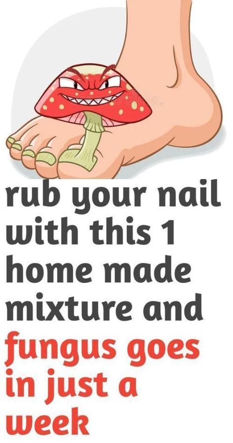 People go crazy for his recipe! toenail fungus remove in just one week!#killsnail #treatmentfungus #nailfungus #toenailfungus #fungus #fungustretment #fungustoenail Fungal Infection Remedies, Toenail Health, Toenail Removal, Toenail Fungal Infection, Diy Medicine, Toenail Fungus Remedies, Types Of Fungi, Nail Fungus Remedy, Fungal Nail