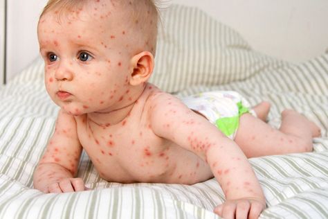 Your skin breaks out in itchy rashes, painful blisters, or crusty sores. Allergies? Eczema? The answer could be a viral infection. Viral Rash, Common Skin Rashes, Baby Umbilical Cord, Skin Breaking Out, Itchy Rash, Snoring Remedies, Dry Skin Patches, Viral Infection, Class Room