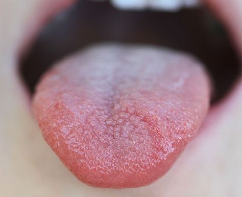 Transient lingual papillitis, aka lie bumps or liar’s tongue, happens when something riles up bumps on your tongue that contain your taste buds. Lie Bumps On Tongue Remedy, Lie Bumps On Tongue, Inflamed Taste Buds, Tongue Infection, Blister On Tongue, Bumps On Tongue, Tongue Taste Buds, Sore Tongue, Ulcer On Tongue