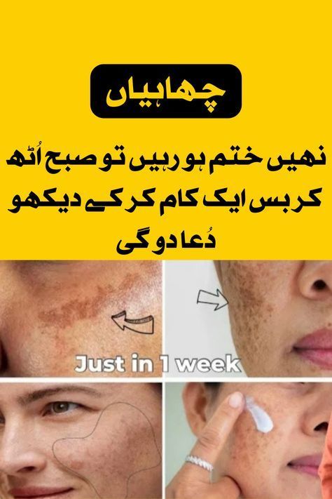 very effective remedy of morning routine of feckles ladies for removing freckles and dark spots Getting Rid Of Freckles, Freckle Remover, Dear Zindagi Quotes, Dear Zindagi, Embroidery Fashion Detail, Beauty Tips For Skin, Baby Frocks Designs, Good Health Tips, Skin Care Recipes