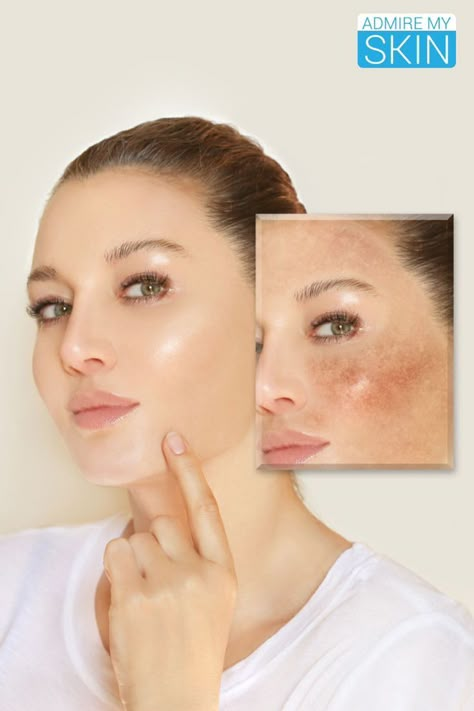 How long does it take for Admire skin to work? Skin Peeling On Face, Get Rid Of Pimples Overnight, Rid Of Pimples Overnight, Oily Skin Type, Skin Blackheads, Oily Skin Remedy, Enzyme Peel, Facial Anatomy, Pimples Overnight