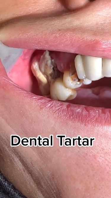 #Teeth_Whitening_Remedies #Dental_Cavities #Digestive_Problems #Whiten_Teeth Whiten Teeth At Home, Dental Videos, Healthy Teeth And Gums, Teeth Whitening Remedies, Digestive Problems, Whiten Teeth, How To Prevent Cavities, Oral Care Routine, Gum Care