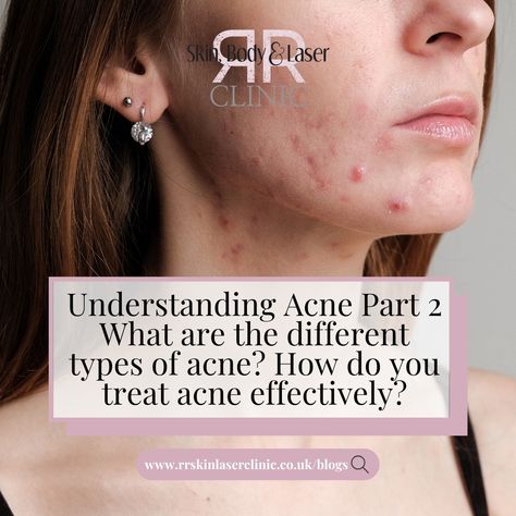 Part two of our Understanding Acne series is now live ✨ We are looking at the different types of acne – from hormonal to cystic and ways to treat the different types of acne..💕 Whether you're battling breakouts on your chin or struggling with stubborn cysts, find out more about our expert tips on how to tackle acne effectively! Head over to the blog to learn more 👉 www.rrskinlaserclinic.co.uk/blogs #acne #acnetreatment #acneadvice #acnetips #acnejourney #acneskincare #acnehelp #blogpost ... Cystic Acne On Chin, Treating Cystic Acne, Chin Acne, Different Types Of Acne, Acne Help, Acne Skincare Routine, Types Of Acne, Acne Facial, Skin Specialist