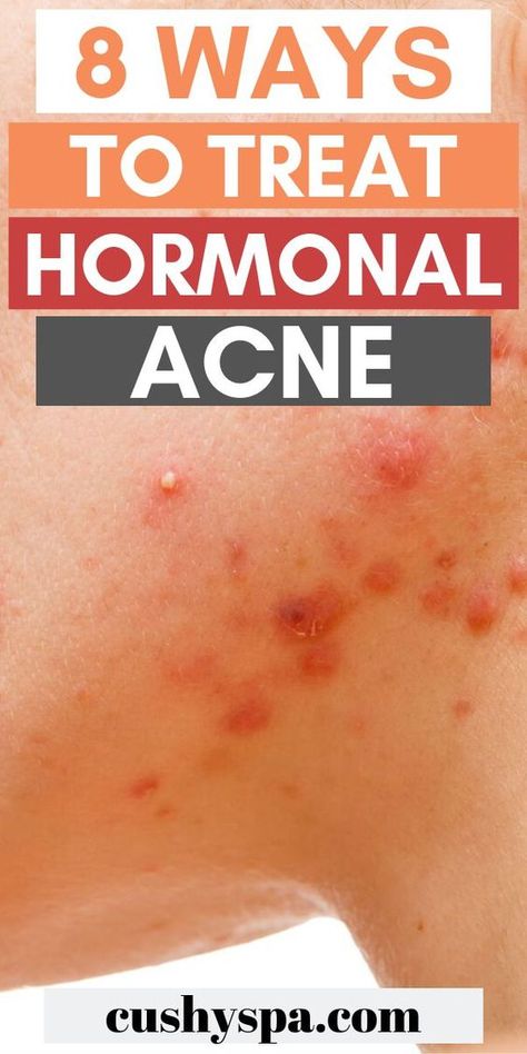 Skincare Tips For Acne, Skin Treatments For Acne, Treat Hormonal Acne, Treatments For Acne, Back Acne Remedies, Face Mapping Acne, Celebrity Acne, Bad Acne, Back Acne