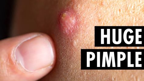 Painful Pimple Under Skin, Hard Pimple, Underarm Pimples, Neck Pimples, Zit Popping Video Faces, Big Zits, Huge Pimple, Nose Pimples, Ear Pimple