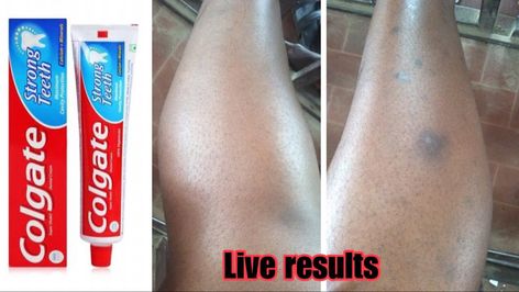 Leg Hyperpigmentation, Leg Scars, Dark Spots On Legs, Getting Rid Of Scars, Colgate Toothpaste, How To Fade, Spots On Legs, Acne Free Skin, Dark Spots On Face