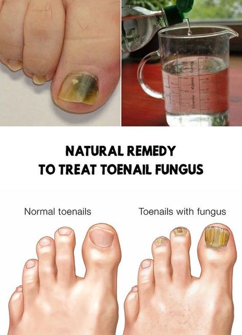 Fungal nail infections should be treated as soon as we detect them. In today's article, we present a natural remedy for toenail fungus. Nail Fungal Infection Toenails, Toe Fungus Remedy, Toe Nail Fungal Infection, Toenail Care, Infected Toenail, Toenail Fungal Infection, Nail Discoloration, Nail Remedies, Nail Conditions