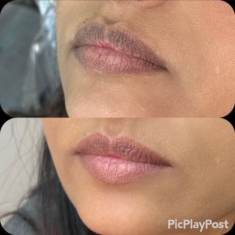 Lip neutralization! This is a beautiful example of what lip blush can do for people with hyperpigmentation of the lips. If it bothers you, book a consultation with me and I’ll tell you how I can help! 💕💋 #redefined #redefineyourself #permanentmakeup #cosmetictattoo #paramedicaltattoo #microblading #ombrebrows #powderbrows #lipblush #eyelinertattoo #cedarrapids #iowa #marion #wakeuplikethis Lip Neutralization, Abdominal Stretches, Skin Bumps, Lip Blush, Eyeliner Tattoo, Cosmetic Tattoo, Medical Terms, Natural Lips, Permanent Makeup