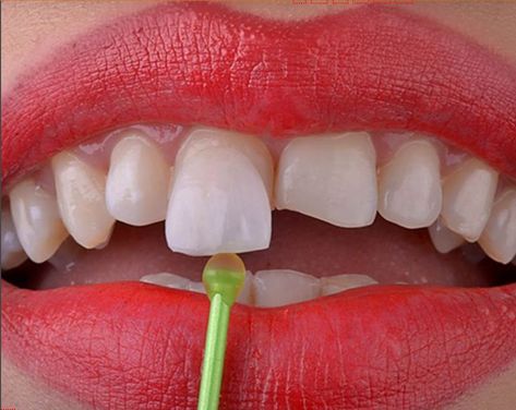 Porcelain Veneers cost in India Composite Veneers, Porcelain Veneers, Dental Veneers, Smile Makeover, Smile Design, Dental Lab, Natural Teeth, Mumbai India, Cosmetic Dentistry