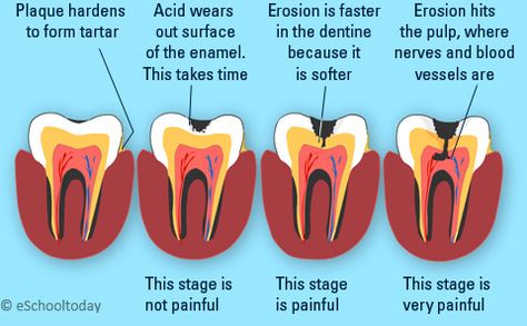 Stages of tooth decay explained Tooth Extraction Aftercare, Tooth Extraction Healing, Dental Advertising, Dental Decay, Tooth Decay Remedies, Teeth Whitening Homemade, Dental Cavities, Teeth Whitening Toothpaste, Dental Facts