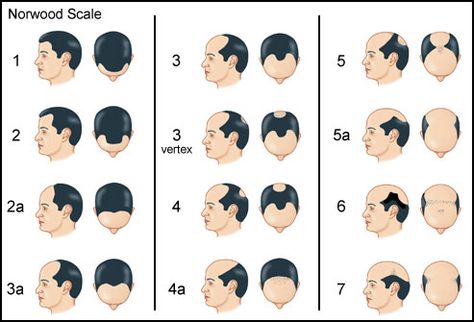 Norwood Scale (Baldness Chart) Hair Transplant Women, Baldness Solutions, Hair Transplant Results, Hair Transplant Surgery, Best Hair Transplant, Male Pattern Baldness, Hair Thinning, Pattern Baldness, Hair Restoration