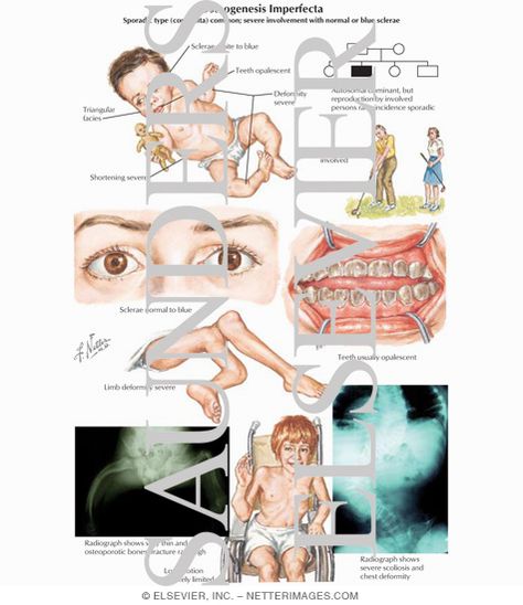 Osteogenesis Imperfecta Osteogenesis Imperfecta, Bone Diseases, Orthopedic Surgery, Med School, Medical Students, School Stuff, Surgery, Nursing, Disease