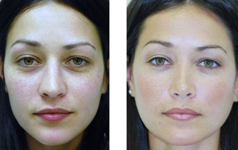 Bulbous Tip Rhinoplasty, Bulbous Nose Rhinoplasty Before After, Rhinoplasty Before After, Meghan Markle Plastic Surgery, Jaw Reduction Surgery, Nose Plastic Surgery, Nose Surgery Rhinoplasty, Body Contouring Surgery, Bulbous Nose