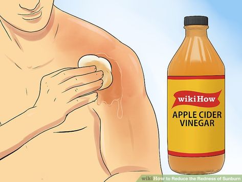 The Best Ways to Reduce the Redness of Sunburn - wikiHow Apple Cider Vinegar Sunburn, Sunburn On Face, Vinegar For Sunburn, Redness On Face, Home Remedies For Sunburn, Get Rid Of Sunburn, Heal Sunburn, Burn Relief, Bad Sunburn