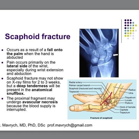 Scaphoid Fracture, Weak Wrists, Nbcot Exam, Ray Film, Health Art, Medical Anatomy, Hand Wrist, School Nurse, X Ray