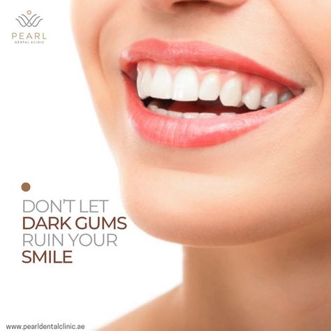 At Pearl dental clinic, our dentist helps patients correct the appearance of gingival hyperpigmentation with advanced laser dentistry techniques. We use laser treatment to minimize the appearance of dark spots on the gums without the need for invasive periodontal surgery. The use of the laser allows for quick healing; the patients can smile confidently with healthy, pink gums after the treatment without worrying that their gums appear unusual. Dark Gums, Dental Laser, Dental Veneers, Dental Clinic, Gum, Conditioner, Quick Saves