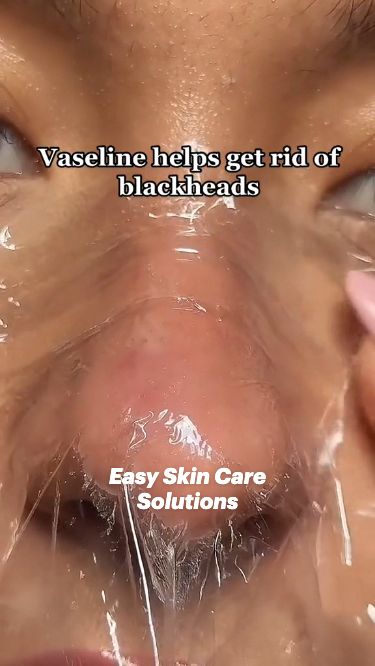 Back Acne Remedies, Glowup Tips, Easy Skin Care, Skin Care Hacks, Blind Pimple, Acne Overnight, Cold Sores, Skincare Hacks, Cold Sores Remedies