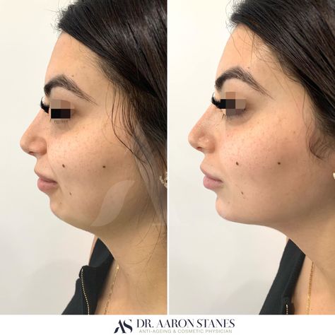 Chin Augmentation Purpose: Add shape and structure to the chin. How it works: Injections using dermal filler. Time it takes: 10-20 minutes Downtime: None Maintenance: Revisit 12-24 months on average Discomfort: Minimal, numbing options available Price: Please see website for our current pricing Suitability: 18+. Not suitable if you’re pregnant or breastfeeding Caution: Must be performed by an experienced, registered practitioner Small Chin, Weak Chin, Chin Augmentation, Chin Chin, Cosmetic Procedures, Dermal Fillers, Double Chin, Side Profile, Pearl Earrings