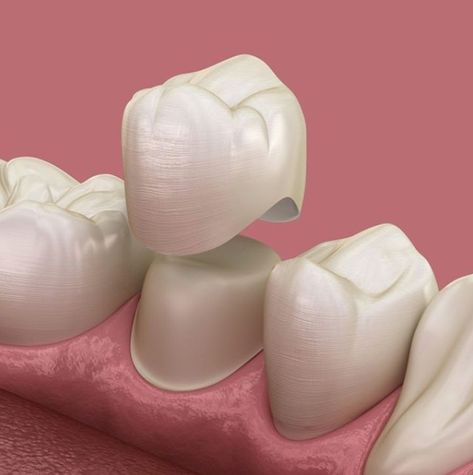 Zirconia Crowns Teeth, Tooth Aesthetic, Crown Teeth, Teeth Crown, Teeth Images, Tooth Crown, Porcelain Crowns, Dental Social Media, Dental Images