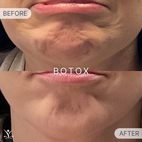 Treating the chin with Botox can make a significant difference in the lower face! Patient has seen a significant difference in the dimpling and wrinkling in and around her chin, and is thrilled with the results! 📲Bellingham (360) 685-8408 📲Burlington (360) 982-2620 📲Bothell (425) 818-4868 . . . #botox #chinbotox #chinwrinkles #wrinkletreatment #rejuvenationmd #washingtonaesthetics #seattlewa #bellinghamwa #burlingtonwa #skagitvalley #bothellwa Botox Room, Botox Forehead, Botox Results, Chin Wrinkles, Diy Natural Detergent, Botox Before And After, Botox Lips, Frozen Face, Botox Fillers