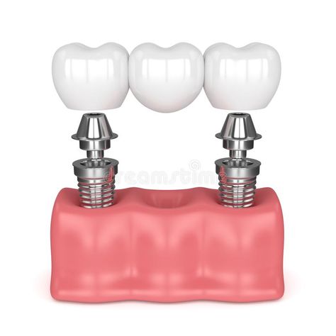 3d render of implants with dental bridge vector illustration Bridge Vector Illustration, Bridge Vector, Teeth Sticker, Creative Facebook Cover, Dental Pictures, Minimalist Graphic Design, Dental Bridge, 3d Render, Background Illustration