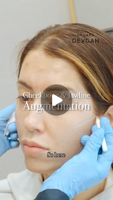 Dr. Lara Devgan, MD, MPH, FACS on Instagram: "Nonsurgical cheekbone and jawline augmentation techniques contribute to facial symmetry and harmony. Through the strategic use of dermal fillers, these procedures enhance facial contours, restoring youthful volume and balance to the midface and lower face regions. 

#facialoptimization #devganoptimization #plasticsurgery #plasticsurgeon #beautyisinthedetails" Cheekbone Filler, Face Balancing Fillers, Facial Balancing, Facial Symmetry, Dermal Fillers, Med Spa, Plastic Surgeon, Plastic Surgery, Facial