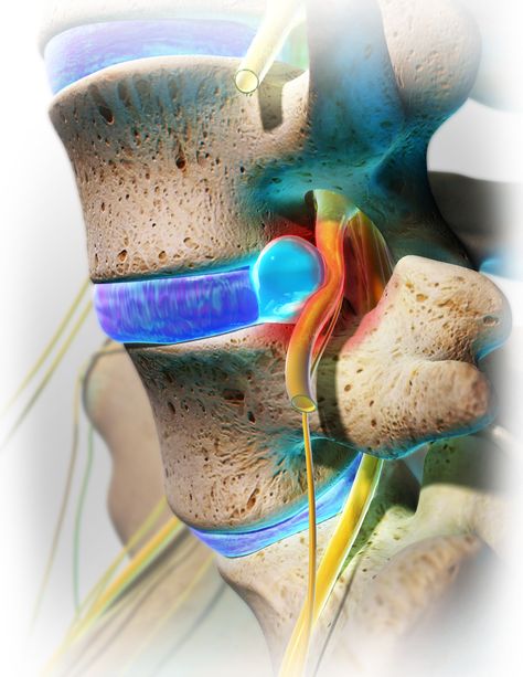 When a patient feels pain due to a herniated disc, the pain is not from the disc itself, rather it's from the disc protruding onto a nerve:  http://www.spine-health.com/conditions/herniated-disc/whats-a-herniated-disc-pinched-nerve-bulging-disc Disc Herniation, Lumbar Disc, Bulging Disc, Disk Herniation, Pinched Nerve, Brain Anatomy, Human Body Anatomy, Spine Health, Medical Anatomy