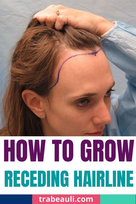 receding hairline style Hair Growth For Receding Hairline, Female Receding Hairline, Hairstyles For Women With Receding Hair, How To Fix Hairline Women, How To Grow Receding Hair Line, Types Of Hairlines Women, How To Get A Better Hairline, Women Receding Hairline Hairstyles, Haircut For Receding Hairline For Women