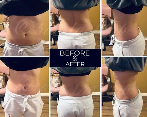 This Babe 2nd Session She Lost 5 inches 🔥…. BABE TIGHTEN AND SCULPT! OUR MOST POPULAR BABE SERVICE IS A COMBINATION OF BREAKING DOWN FAT, BODY CONTOURING AND SKIN TIGHTENING. WE CUSTOMIZE EACH BODY SCULPTING SESSION TO OUR CUSTOMERS NEEDS. 1 HR. SESSION INCLUDES: ✅CAVITATION ✅VACUUM THERAPY ✅RADIO FREQUENCY ✅LASER LIPO ✅WOOD THERAPY 🚫 NO DOWNTIME ⏳DURATION: 1- 1.5 HRS. CONTACT US TO BOOK YOUR APPOINTMENT! 📍CORONA, CA 📲 949-247-4786 #bodysculpting#bodyconturing#cellulite#skintightening... Vacuum Therapy, Wood Therapy, Laser Lipo, Radio Frequency, Book Your Appointment, Body Sculpting, Body Contouring, Skin Tightening, Body Goals