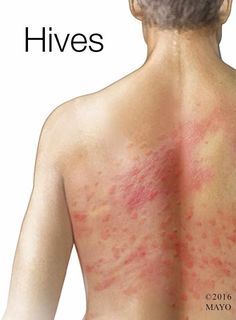 Mayo Clinic Q and A: Chronic Hives Come and Go With No Clear Pattern – Mayo Clinic News Network Hives Relief, Natural Remedies For Hives, Skin Rash Remedies, Allergy Hives, Hives Causes, Allergic Reaction Rash, Hives Remedies, Chronic Hives, Hot Curlers