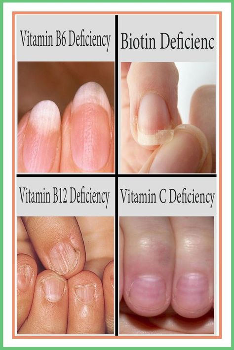 Nail Health Signs, Nail Structure, Vitamin B6 Deficiency, Fingernail Health, Nail Signs, Mineral Deficiency, Zinc Deficiency, Nail Vitamins, Vitamin B12 Deficiency