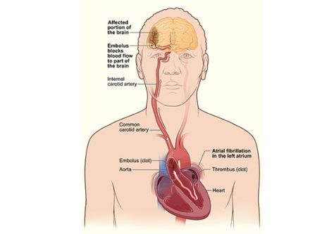 Inactivity Raises Chance Of Stroke: People Who Don't Exercise Have 20% Higher Risk, Study Says - Forbes Atrial Fibrillation Symptoms, A Fib, Internal Carotid Artery, Home Remedies For Snoring, Carotid Artery, How To Stop Snoring, Atrial Fibrillation, Cardiovascular System, Chest Pain