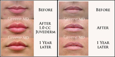 Lip Augmentation and Enhancement Expert Weston and Fort Lauderdale | South Florida Filler Specialist Dr. Ryan Greene Small Lip Fillers Before And After, Perfect Lips Injections, Lip Filler Healing Stages, Lip Injections Shapes, Lip Filler Shape Ideas, Lip Remedies, Lip Filler Inspiration, Lip Fillers Juvederm, 1ml Lip Filler