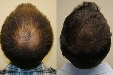 Shedding Before and After a #Hair #Transplant Read More: http://hairnsenses.co.in/shedding-before-and-after-a-hair-transplant.php Hair Transplant Before And After, Before And After Acne, Before And After Hair, Aesthetic Dermatology, Esthetics Room, Fue Hair Transplant, Hair Transplant Surgery, Male Pattern Baldness, Pattern Baldness