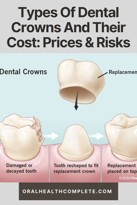 Types Of Dental Crowns And Their Cost Porcelain Crown Front Teeth, Front Teeth Crowns Before And After, Dental Crowns Before And After, Zirconia Crowns Teeth, Permanent Gold Teeth, Porcelain Crowns, Tooth Crown, Tooth Repair, Tooth Replacement