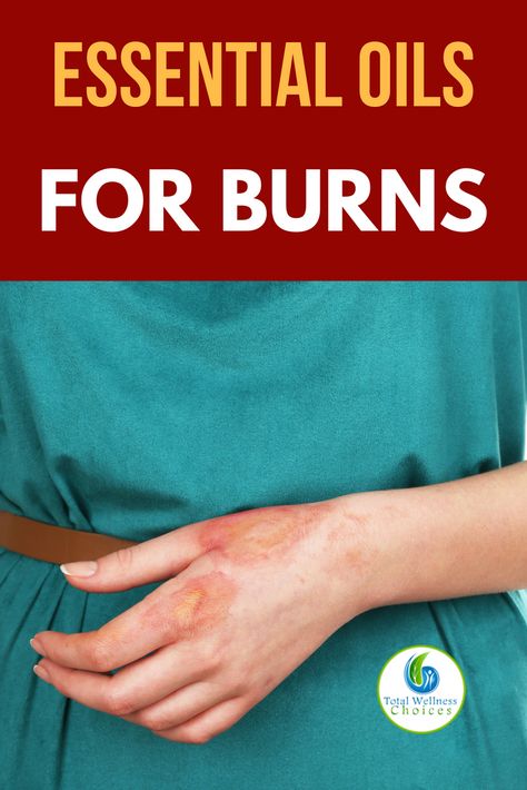 Best Essential Oils for Burns Essential Oil For Burns, Home Remedies For Burns, Burn Remedy, Burn Relief, Oils For Sinus, Essential Oils For Colds, Essential Oils For Pain, Essential Oils For Headaches, Skin Burns