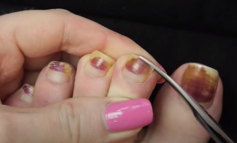 This is a guide to giving yourself a toenail makeover. Learn how to do a pedicure at home with this easy step-by-step beauty tutorial. How To Paint Toenails Perfectly, Nail Dremel, Base Coat Nail Polish, Toenail Art, Diy Pedicure, Nail Base Coat, Beauty Tutorial, Ingrown Toenail, Nail Infection