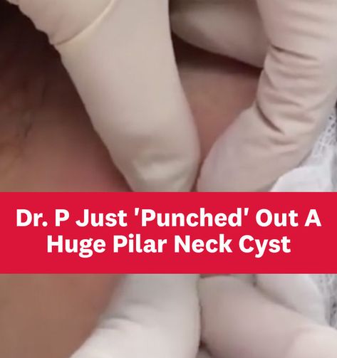 "It's a knockout. 🤜🏻💥" Pilar Cysts On Scalp, How To Get Rid Of Cysts On Face, Dr Pimple Poppìng Videos, Removing Blackheads From Nose Videos, Popping Pimples Videos, Cystic Pimple Pop, Cysts Popping Videos, Pimple Poppìng Videos Satisfying, Boil Popping Videos