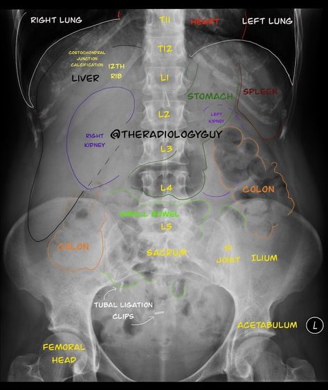 376 Me gusta, 5 comentarios - 𝕋𝕙𝕖ℝ𝕒𝕕𝕚𝕠𝕝𝕠𝕘𝕪𝔾𝕦𝕪 (@theradiologyguy) en Instagram: "The ABDOMEN X-RAY:  I alway found this exam to be tougher than the chest X-ray. So what do I look…" Radiology Schools, Medical Radiography, Vascular Ultrasound, Radiology Student, Radiology Technician, Radiology Imaging, Nursing School Essential, Medical School Life, Basic Anatomy And Physiology