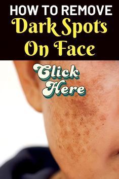 I Use This Natural Recipe For Glowing Glass Skin & Dark Spots...... Overnight Remedies, Wrinkle Remedies, Dark Spots On Face, Natural Face Skin Care, Brown Spots Removal, Brown Spots On Face, Dark Spots On Skin, Spots On Face, Healthy Advice