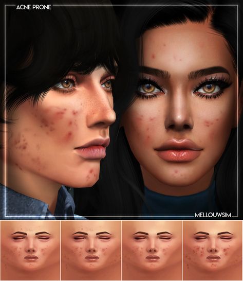 ACNE PRONE MASK | PUBLIC DOWNLOAD | TS4 GET IT ON MY WEBSITE or Ad-free on PATREON x4 Swatches HQ Compatible Found in Skin Details No WCIF Please | Thank you to all the CC creators Any problems don’t... Sims 4 Cc Alien Makeup, Sims Acne, Sims4 Cc Skin, Cc Skin, The Sims 4 Skin, The Sims 4 Pc, Free Sims 4, Skin Details, Sims 4 Mm Cc