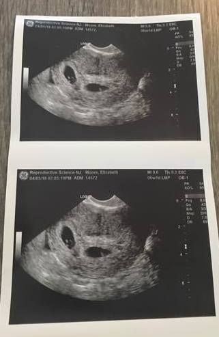 6 Weeks Pregnant with Twins Pregnant 6 Weeks, 5 Week Ultrasound Pictures, Ultrasound Pictures Twins, Twin Ultrasound Pictures, Twin Ultrasound, Twin Sonogram Ultrasound, Pregnant Pictures, Twins Ultrasound 6 Weeks, Twin Ultrasound 6 Weeks