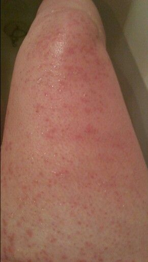 PUPPP rash help--- a few baths with Epson salt and tea tree oil made the rash go away in about a week.  Not too hot in the tub and soak as long as you can. a benadryl every night before bed.A lot of places suggested heavily to keep the rash moisturized; I, however, found that I found the most relief when it was drying out. When I showered, I washed with a tea tree shampoo (it's what we had).Witch hazel was a calming astringent which left no residue (that kept the itch at bay in between baths) Rash On Hands, Allergy Rash, Creative Snaps For Snapchat, Epson Salt, Tea Tree Shampoo, Heat Rash, Hospital Photography, Healthy Life Hacks, Blur Photography