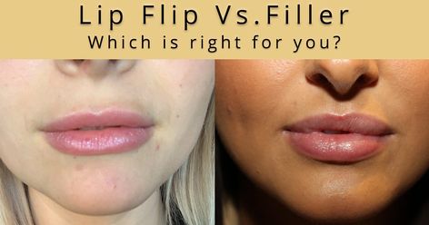 Botox Under Eyes, Botox Lip Flip, Upper Lip Wrinkles, Botox Quotes, Lip Flip, Botox Brow Lift, Lip Lift, Botox Before And After, Botox Lips