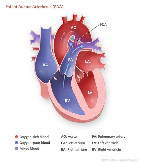 Patent Ductus Arteriosus Illustration Cardiology Notes, Cardiac Assessment, Patent Ductus Arteriosus, Patient Care Tech, Cardiac Sonography, Medical Terminology Study, Medical Laboratory Technician, Congenital Heart Defect, Heart Defect