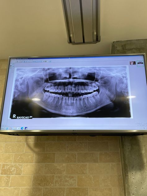 Teeth xray, str8 asfuck Teeth Xray, X Ray, School Projects, Quick Saves